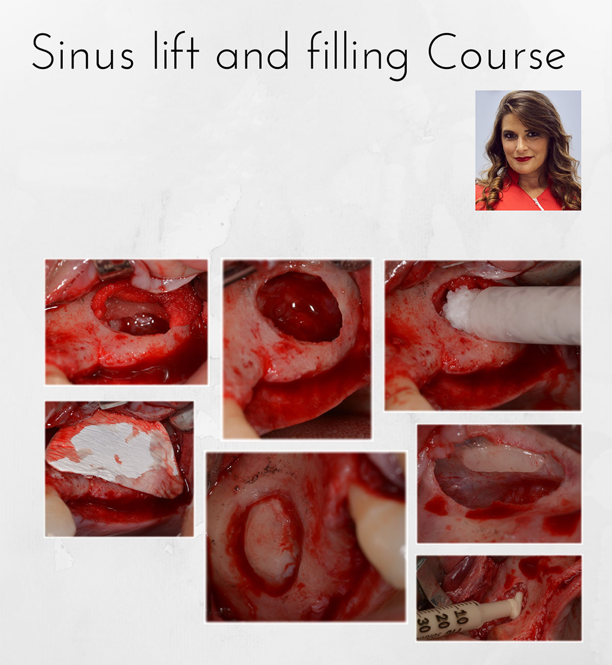 Sinus lift and filling Course